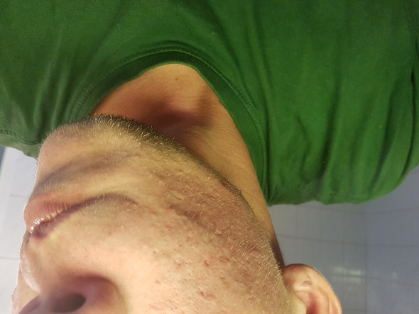 - (Gesundheit und Medizin, Haut, Pickel)