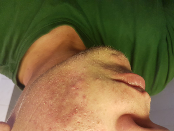- (Gesundheit und Medizin, Haut, Pickel)