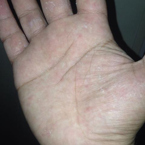 Bei Meiner Hand Und Fussinnenflache Schalt Sich Die Haut Ab Was Kann Das Sein Bei Meiner Hand Und Fussinnenflache Schalt Sich Die Haut Ab Was Kann Das Sein