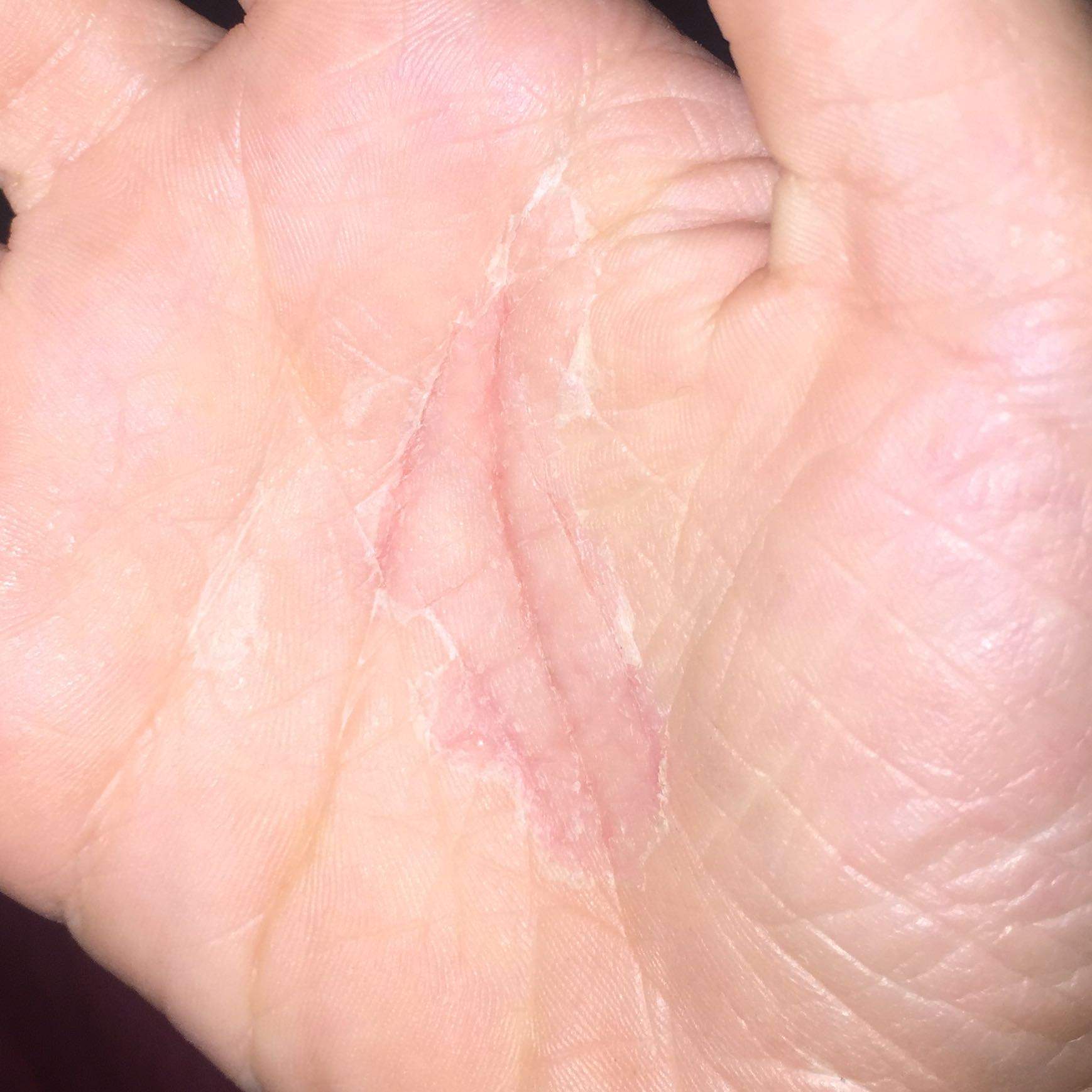 Meine Haut an den Händen schält sich? (Medizin, Hand) Meine Haut an den Händen schält sich? (Medizin, Hand)