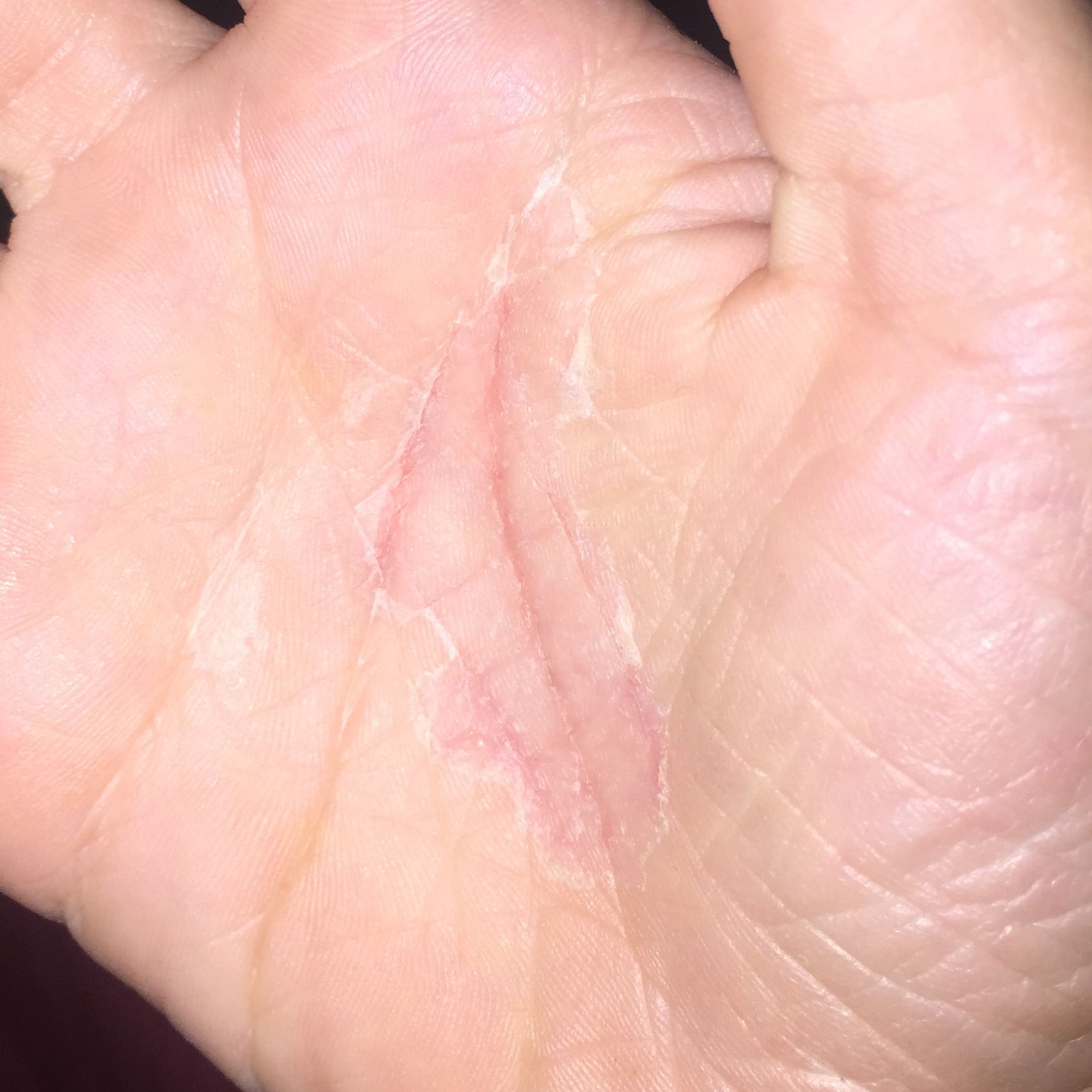 Meine Haut an den Händen schält sich? (Medizin, Hand)