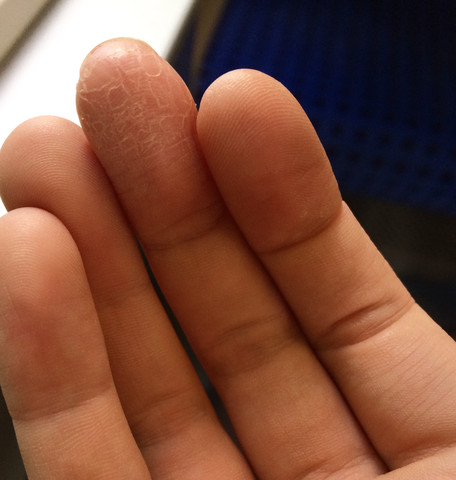 Finger Nahaufnahme - (Gesundheit, Krankheit, Haut)