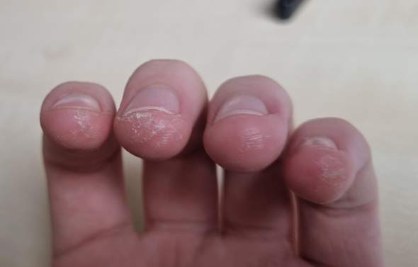 Meine Haut auf den Fingerkuppen reißt aus?