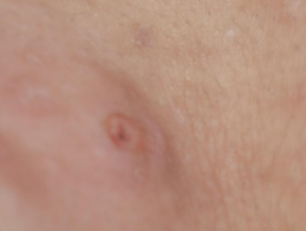 Meine Haut Hat Ein Loch D Pickel Entzundung Heilung Meine Haut Hat Ein Loch D Pickel Entzundung Heilung