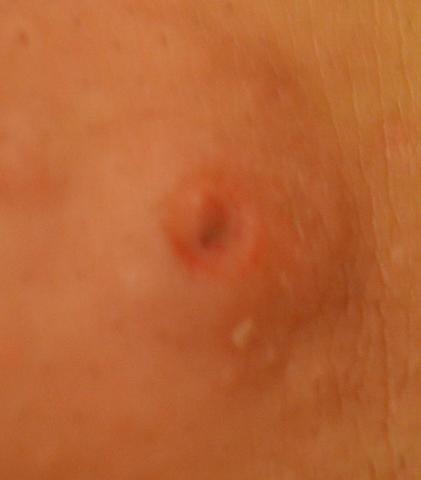 Meine Haut Hat Ein Loch D Pickel Entzundung Heilung Meine Haut Hat Ein Loch D Pickel Entzundung Heilung