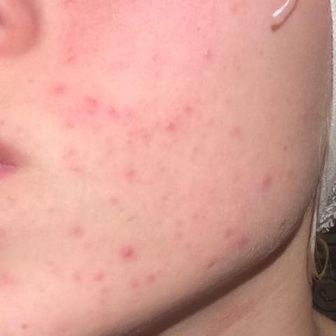 Meine Haut Im Gesicht Wange Pickel Allergie Rotung
