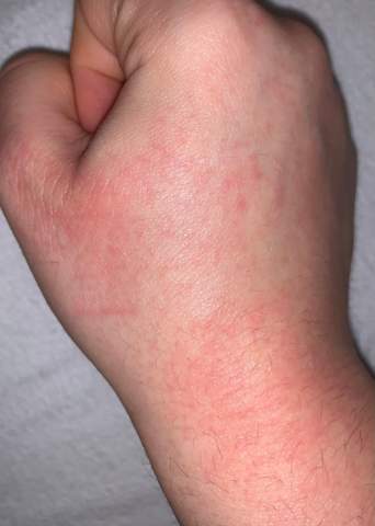 Meine Haut ist sehr trocken.. Sind diese Roten Punkte normal?