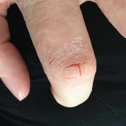 Finger 1 - (Schmerzen, Haut, trockene Haut)