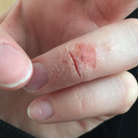 Finger 2 - (Schmerzen, Haut, trockene Haut)