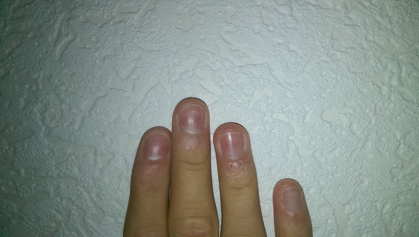 So sehen alle meine Finger aus. - (Haut, Hautpflege, Hand)