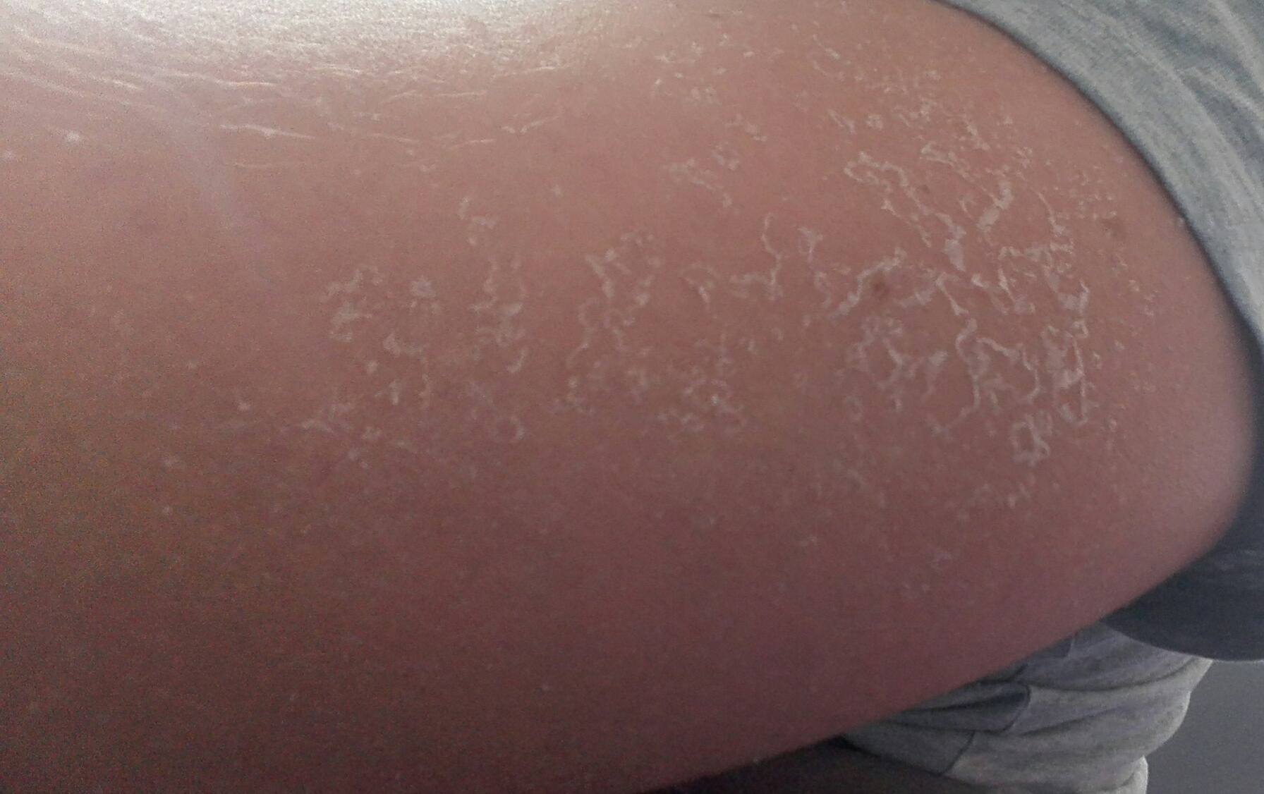 Meine Haut Schalt Sich Ohne Sonnenbrand Linker Arm Gesundheit Und Medizin Schalen Meine Haut Schalt Sich Ohne Sonnenbrand Linker Arm Gesundheit Und Medizin Schalen