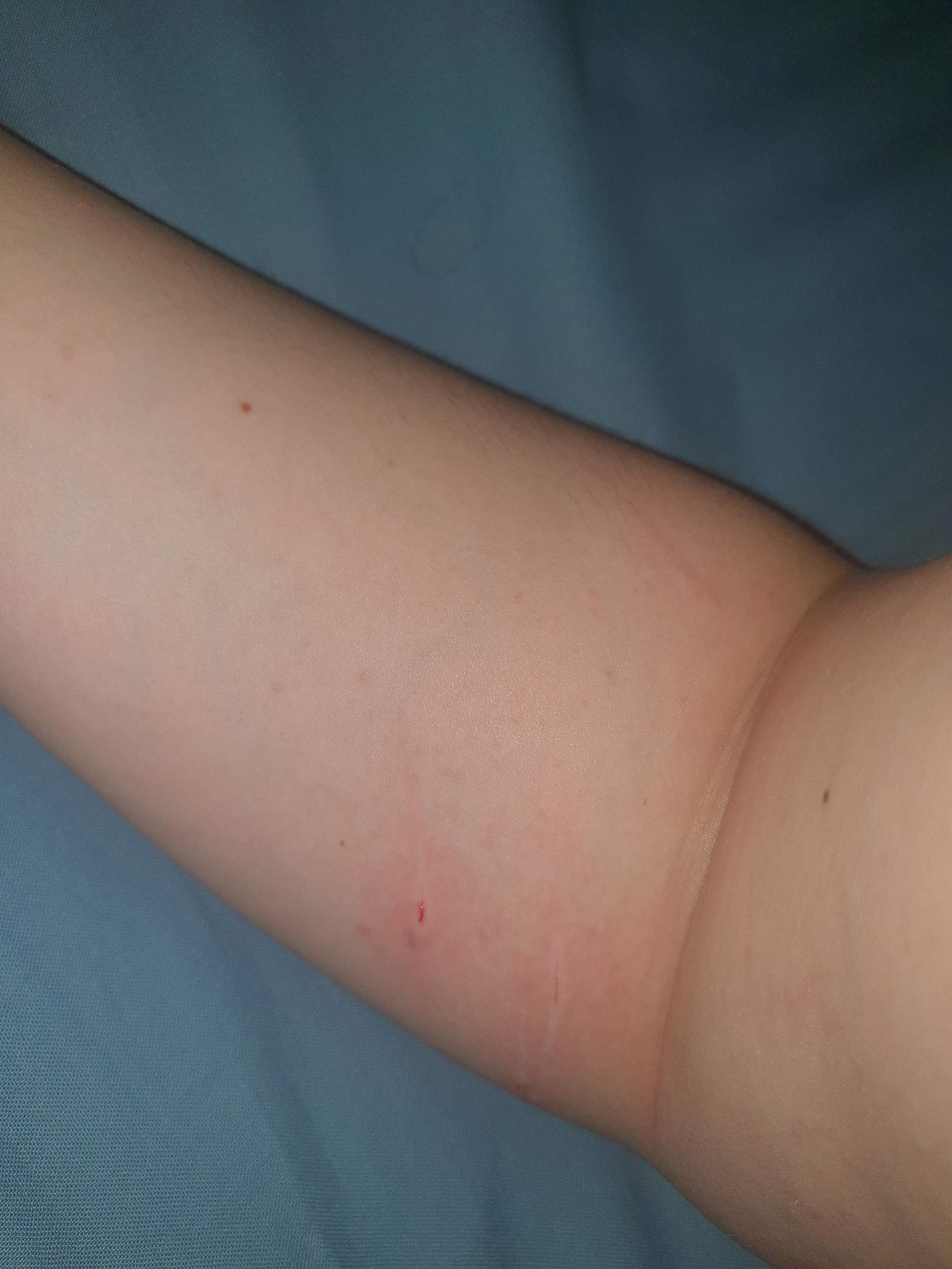 Katze Hat Mich Gekratzt Und Jetzt Schwellung Meine Katze hat mich gekratzt. Wie lange dauert es bis es weg ist, und