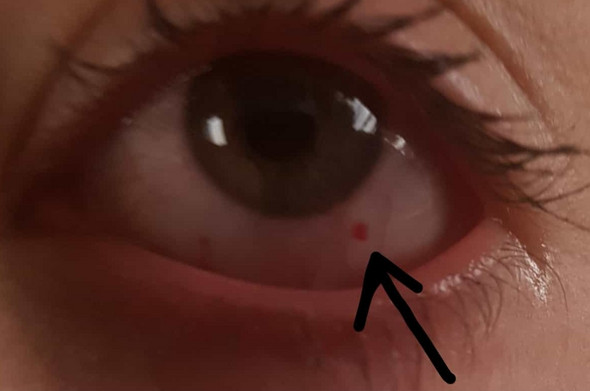 Meine Katze Hat Mir Ins Auge Gestochen Arzt Arztbesuch