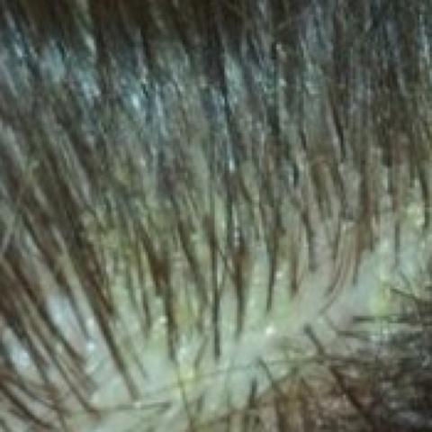 Sieht eklig aus, aber ich wollte das ihr wisst was ich mit der Kruste meine. - (Haare, Kopf, jucken)