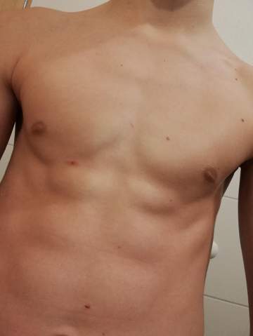 Meine Linke Brust Ist Nicht So Wie Die Rechte Wie Man Sehen Kann Fehlt Dort Ein Stuck 14 Gesundheit Und Medizin Sport Medizin Meine Linke Brust Ist Nicht So Wie Die Rechte Wie Man Sehen Kann Fehlt Dort Ein Stuck 14 Gesundheit Und Medizin Sport Medizin