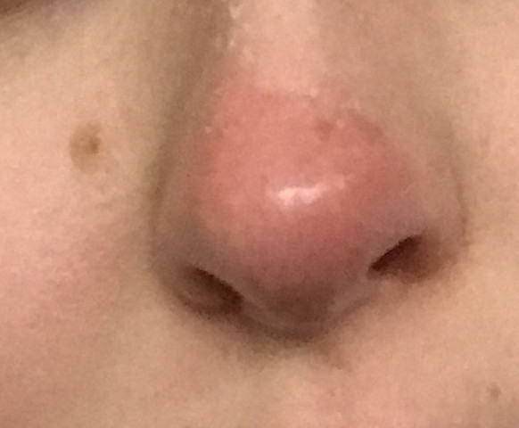 Meine Nase ist rot und angeschwollen. Weis jemand etwas darüber?