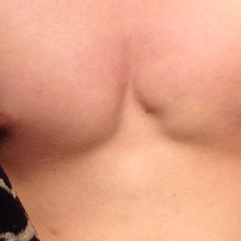 Meine Rechte Brust Nich So Wie Die Linke Wieso Fehlt Da Ein Stuck Training Unterschied Meine Rechte Brust Nich So Wie Die Linke Wieso Fehlt Da Ein Stuck Training Unterschied