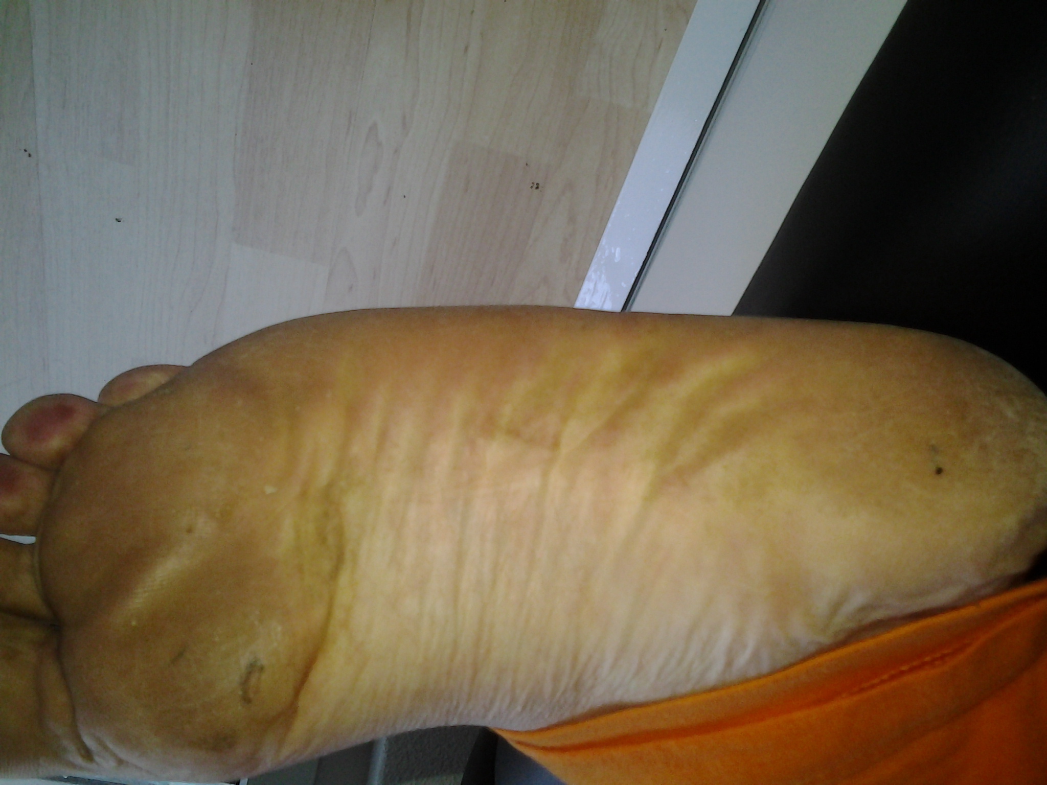 Meine Schwester, hat einen Stachel im Fuss! (Orthopäde, Sportverletzung ...