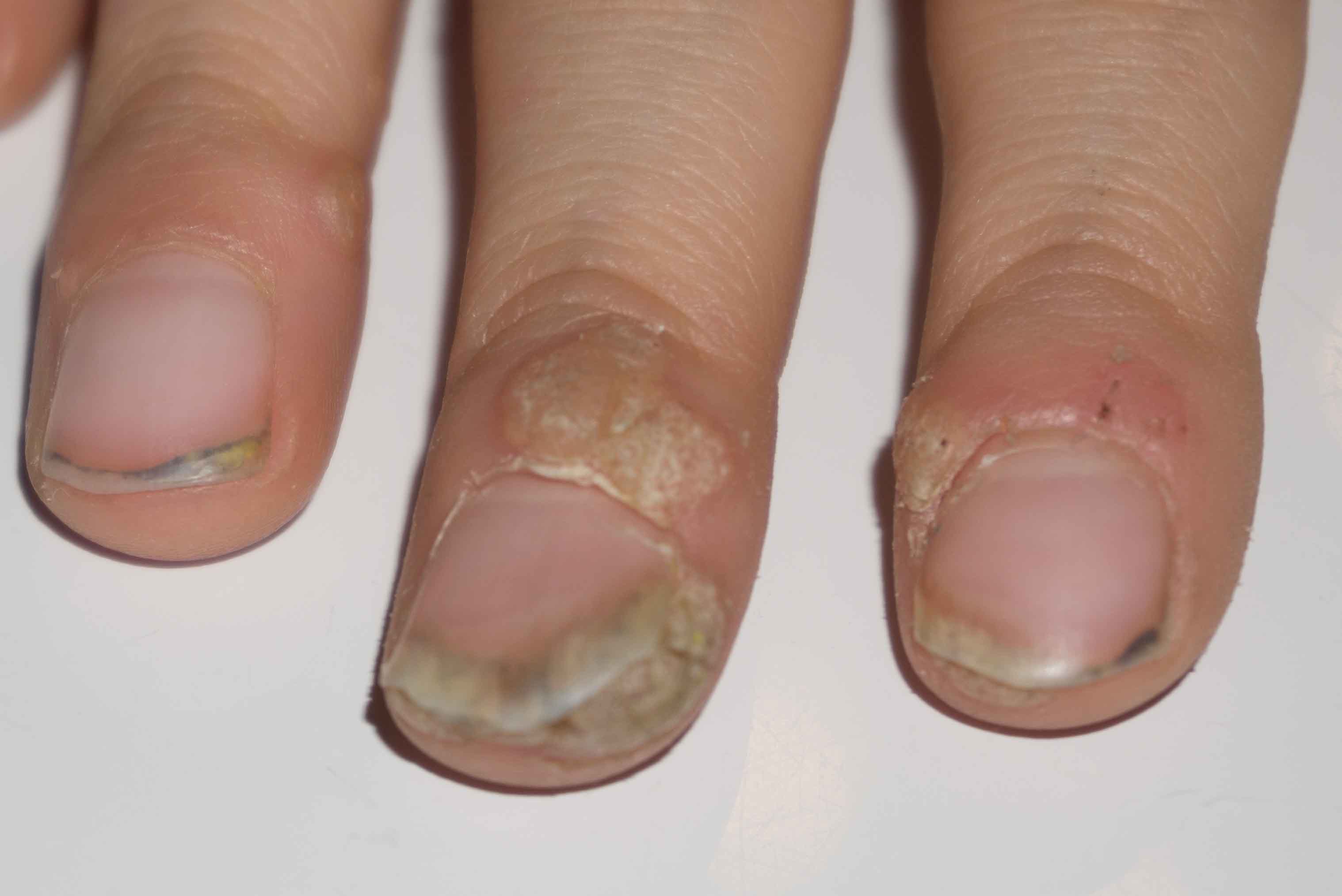 Meine Tochter (6) hat an den Fingern Warzen, die wir seit Jahren nicht in den Griff bekommen Meine Tochter (6) hat an den Fingern Warzen, die wir seit Jahren nicht in den Griff bekommen