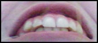 meine zähne - (Bilder, Zähne)