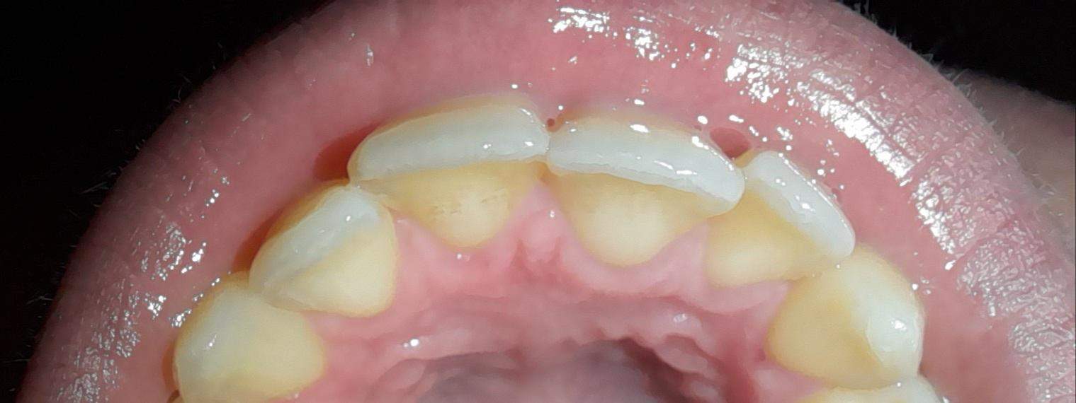 Meine Zähne nach 4 Jahren Zahnspange wieder schief?