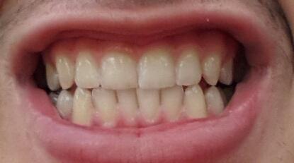 Gelbe Zähne Weiß Bekommen