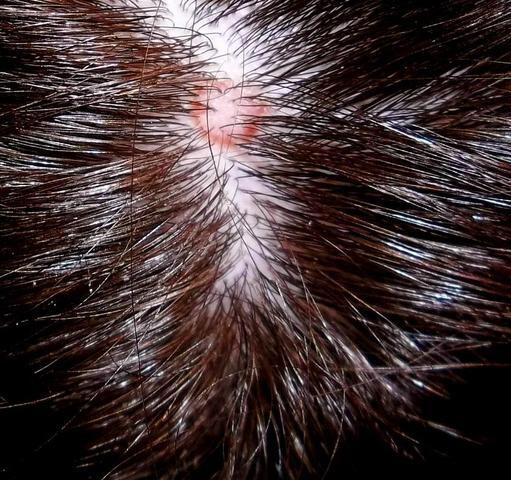 Kreise Rot Kopfhaut - (Kopfhaut, Dermatologie)