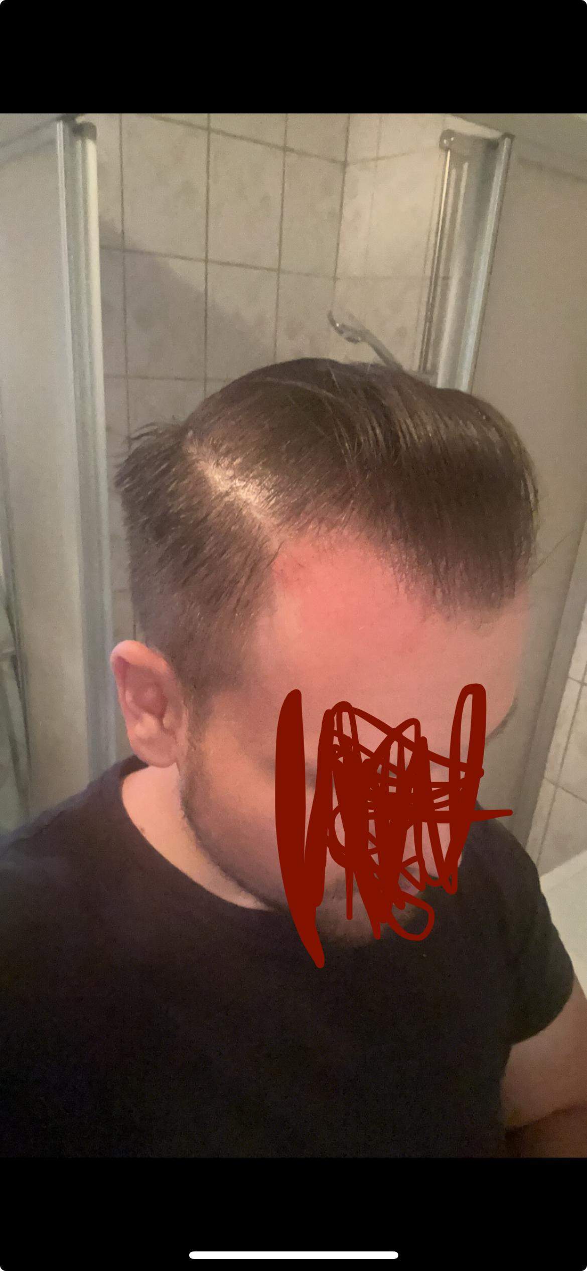 Meint ihr eine Haartransplantation zahlt sich schon aus? (Männer ...