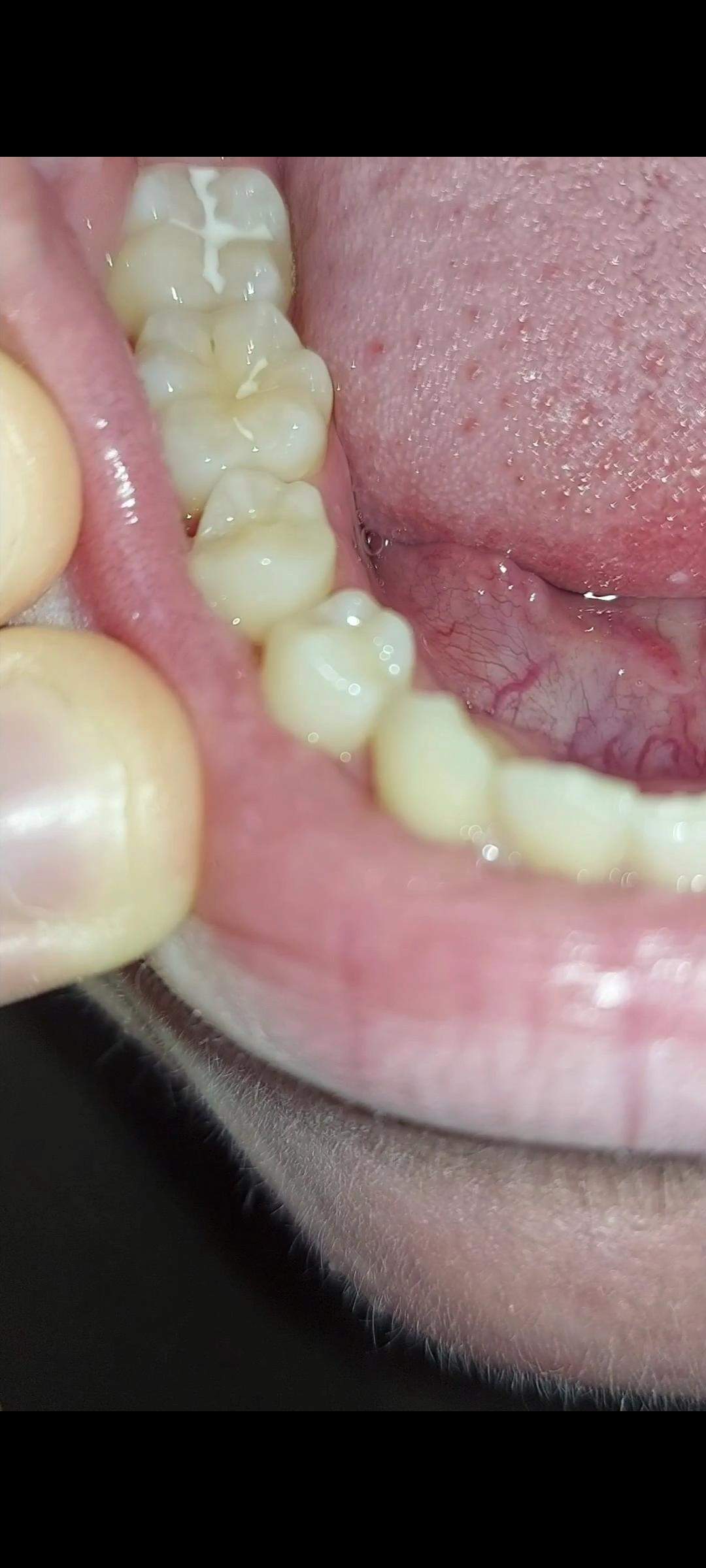 Meinung zu meinen Zähnen? (Zähne, Karies, zaehneziehen)