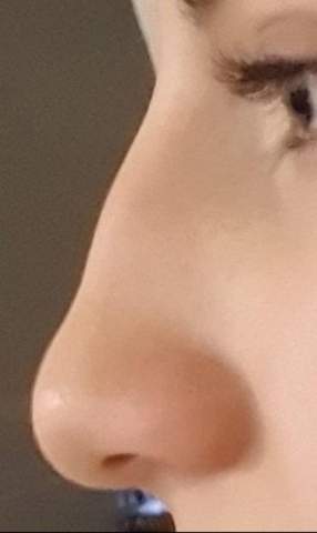 Meinung Zu Nase Aussehen Schonheit Nasen Op Meinung Zu Nase Aussehen Schonheit Nasen Op