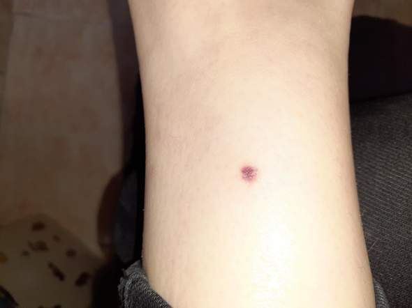 Melamon Hautkrebs Melanom Melamon Hautkrebs Melanom