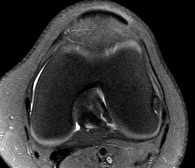 Meniskus Plica MRT Bilder (Medizin, Orthopädie)