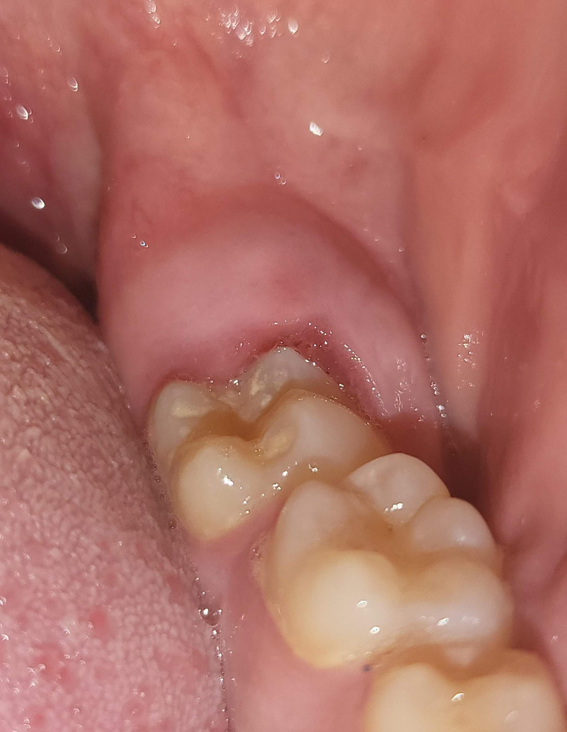 Merkwürdige Beule/ Schwellung am Zahnfleisch? (Gesundheit und Medizin, Gesundheit, Zähne) Merkwürdige Beule/ Schwellung am Zahnfleisch? (Gesundheit und Medizin, Gesundheit, Zähne)