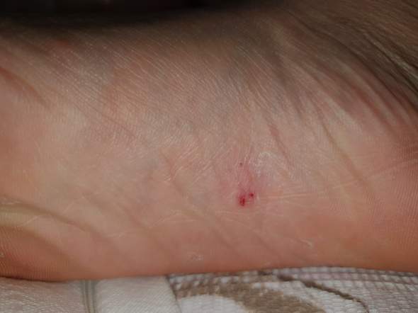 Merkwürdige Bläschen am Fuß? (Gesundheit und Medizin, Juckreiz, blaeschen)