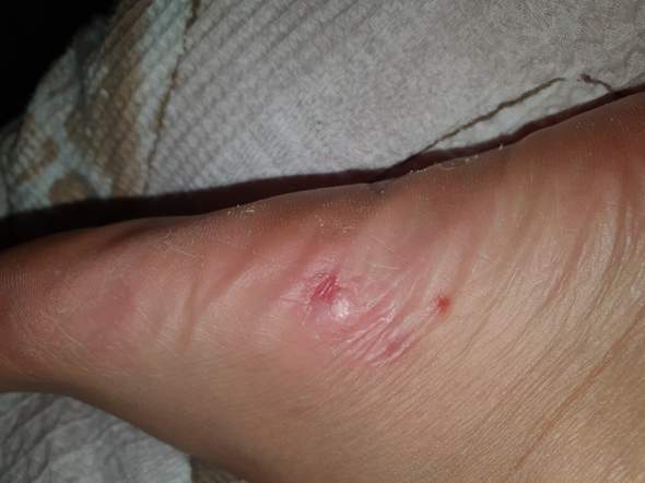 Merkwurdige Blaschen Am Fuss Gesundheit Und Medizin Juckreiz Blaeschen Merkwurdige Blaschen Am Fuss Gesundheit Und Medizin Juckreiz Blaeschen