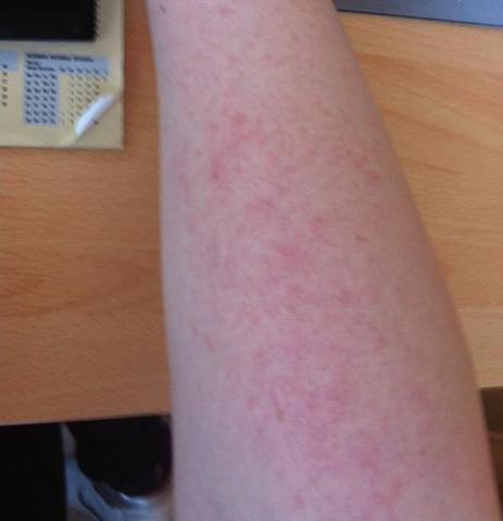Merkwurdiger Ausschlag O Sonne Arm Merkwurdiger Ausschlag O Sonne Arm
