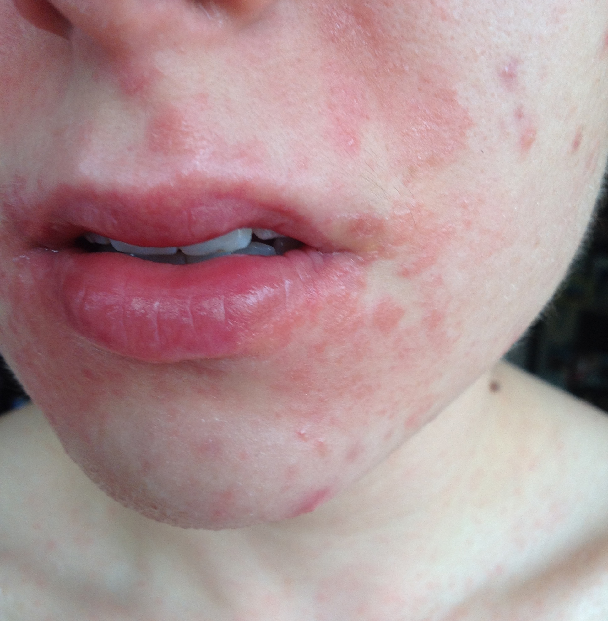 Merkwürdiger Hautausschlag, bitte um Hilfe! (Haut, Juckreiz, Ausschlag)