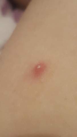 Merkwurdiger Insektenstich Mit Kruste Gesundheit Und Medizin Insekten Stich