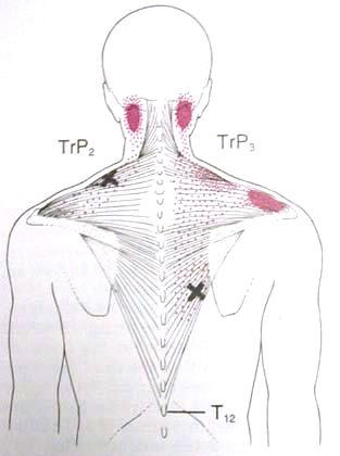 Triggerpunkte im Nacken - (Schmerzen, Muskeln, Kopf)