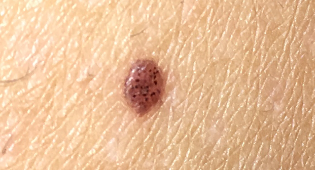 Merkwürdiges Muttermal? (Gesundheit, Körper, Haut)