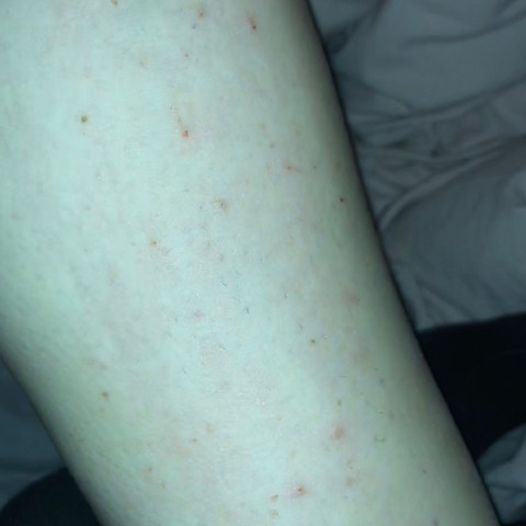 Milben Flohe Oder Einfach Gereizte Haut Gesundheit Und Medizin Allergie Bett Milben Flohe Oder Einfach Gereizte Haut Gesundheit Und Medizin Allergie Bett