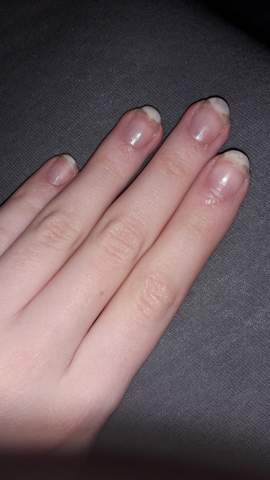 milchig weisse flecken auf den nageln gesundheit und medizin nagel finger