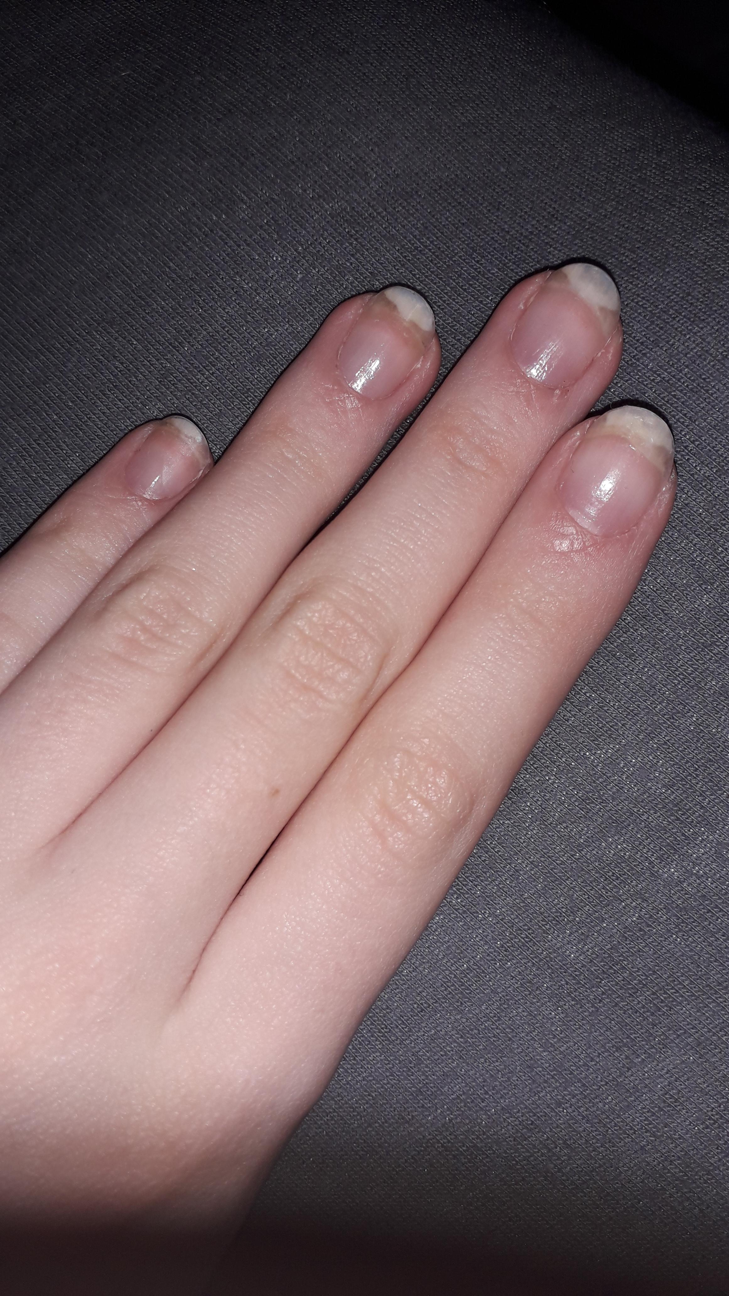 Milchig Weisse Flecken Auf Den Nageln Gesundheit Und Medizin Nagel Finger