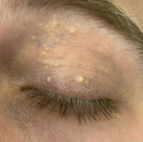 Milien entfernen aber wie? (Gesundheit und Medizin, Haut, Kosmetik)