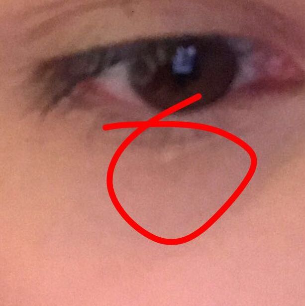 Milien unterm auge , wie behandeln? (Gesundheit und Medizin)