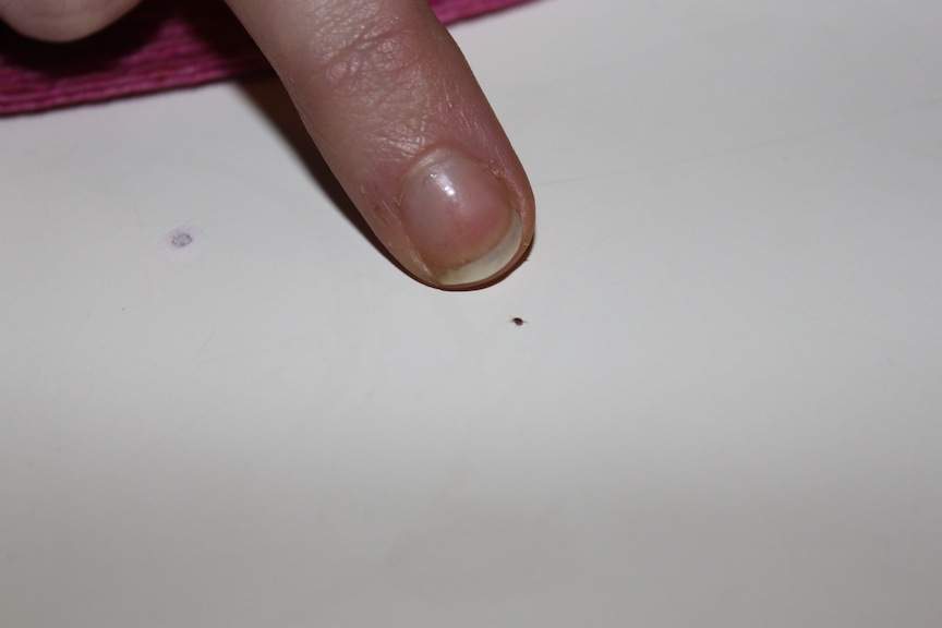 MiniInsekte auf der Haut (Gesundheit, Insekten, Schädlinge) MiniInsekte auf der Haut (Gesundheit, Insekten, Schädlinge)