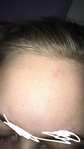 mini pickel an stirn und kinn was tun? (Gesundheit und Medizin) pickel an der stirn ursache