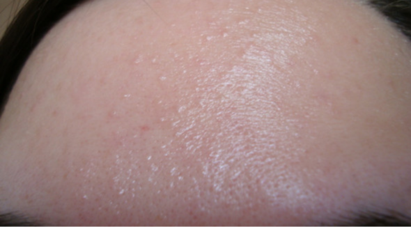 Mini Pickel im ganzen Gesicht, was tun? (Gesundheit und Medizin) pickel mit blut gefüllt im gesicht