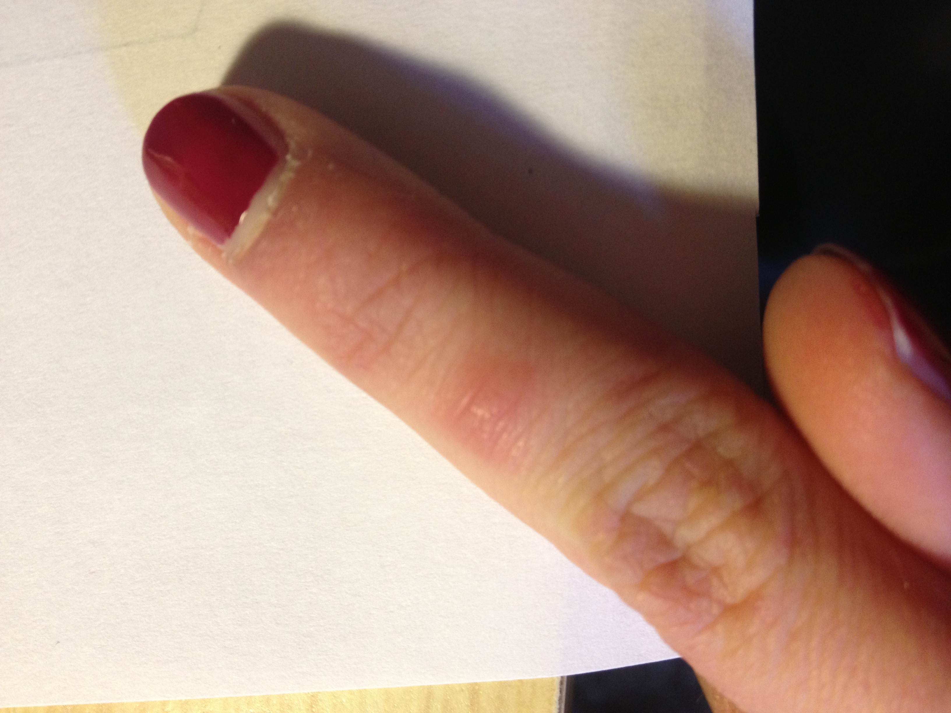 Minibeule am Finger?! (Gesundheit) Minibeule am Finger?! (Gesundheit)