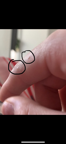 Miniblasen Am Finger Kein Jucken Etc Haut Ausschlag Blasen Miniblasen Am Finger Kein Jucken Etc Haut Ausschlag Blasen